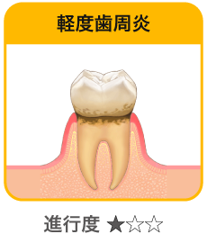 軽度歯周炎