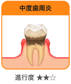 中度歯周炎