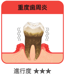 重度歯周炎